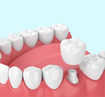 Dental Crowns And Bridges