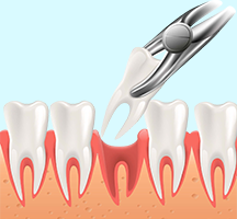 Tooth Extraction