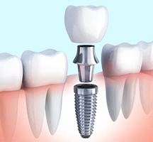 Dental Implants